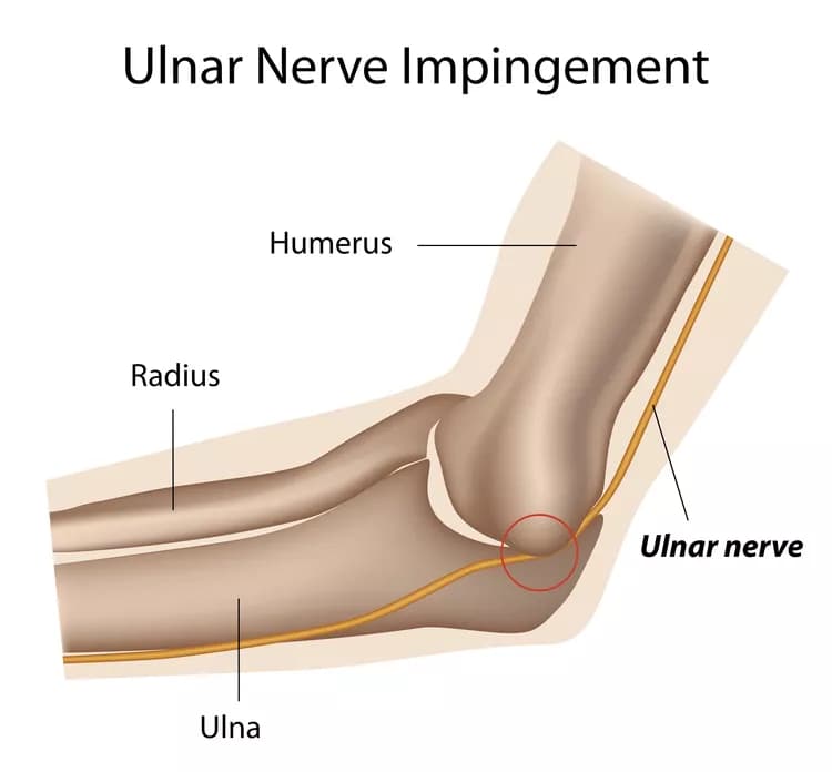 Facts about Ulnar Nerve Entrapment at the Elbow