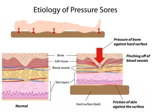 How well do you know Pressure Sores?