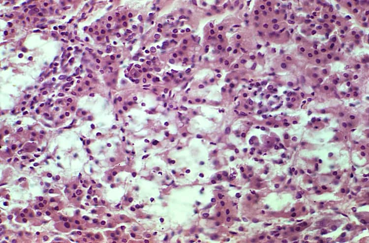 CDC/Dr. Visvera