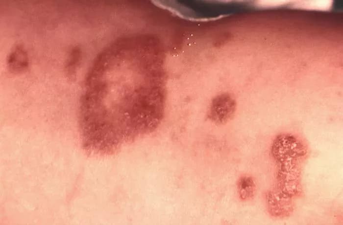 CDC/Dr. Lucille K. Georg