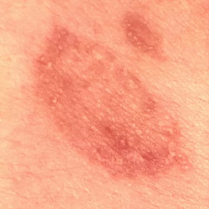 CDC/Dr. Lucille K. Georg