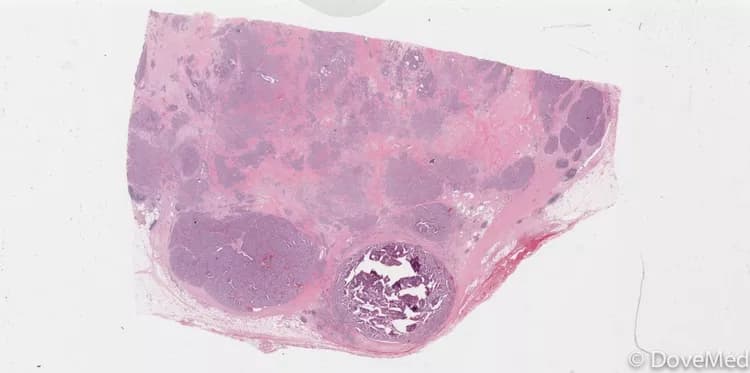 VIPoma of Pancreas