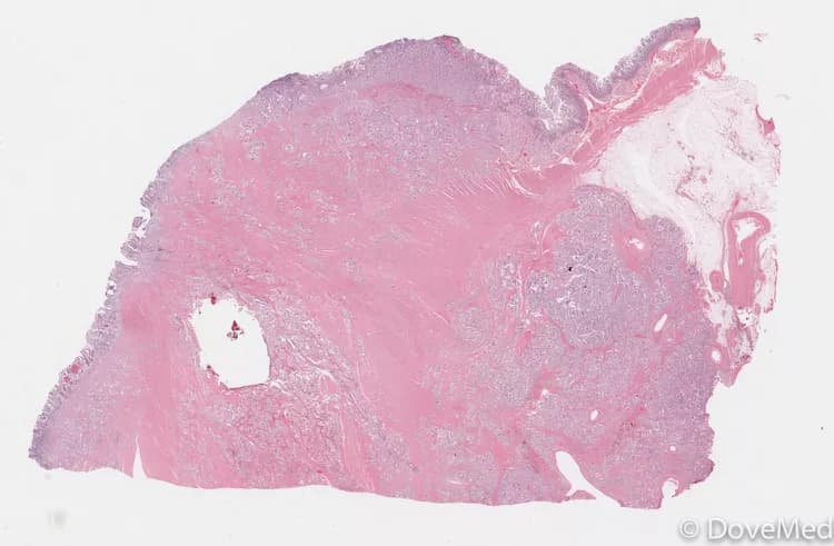 Somatostatinoma