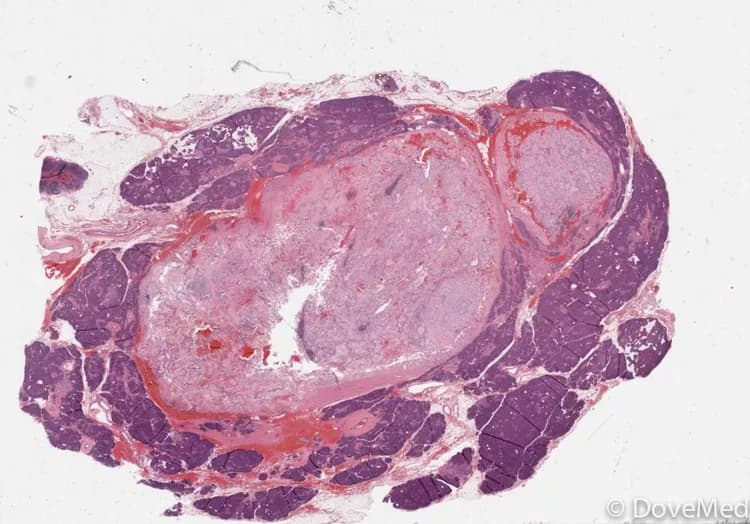Neuroendocrine Tumor of Pancreas
