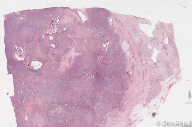 Undifferentiated Carcinoma of Pancreas