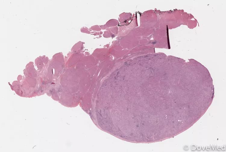 Hepatocellular Carcinoma