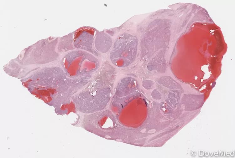 Hepatoblastoma
