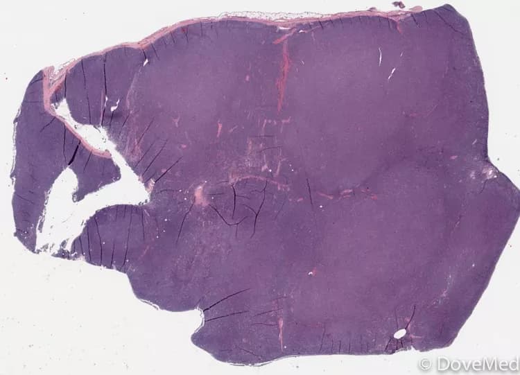 Small Lymphocytic Lymphoma