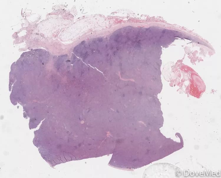 Peripheral T-Cell Lymphoma, NOS