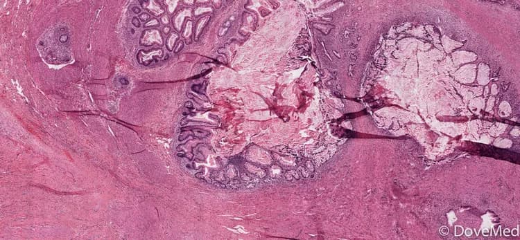 Immature Teratoma of Ovary