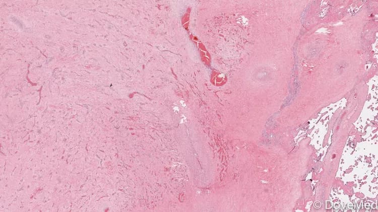 Chorangioma of Placenta