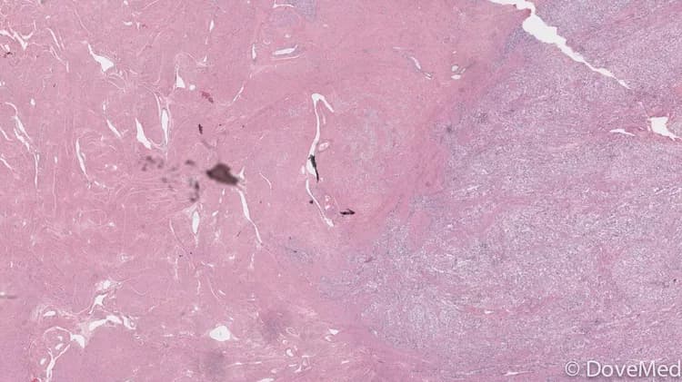 Embryonal Rhabdomyosarcoma of Vagina