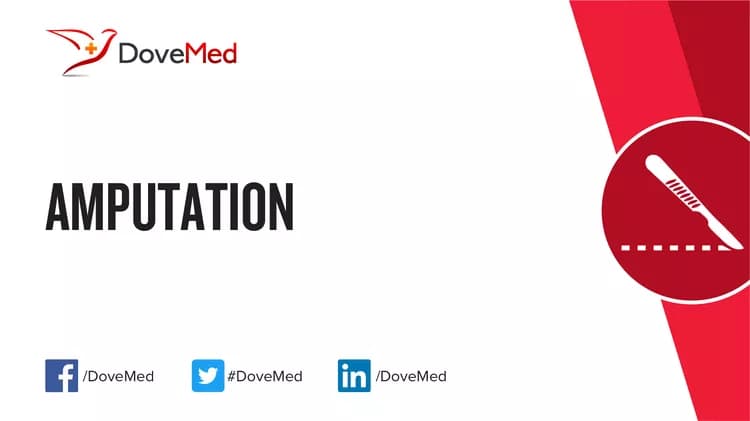 Amputation