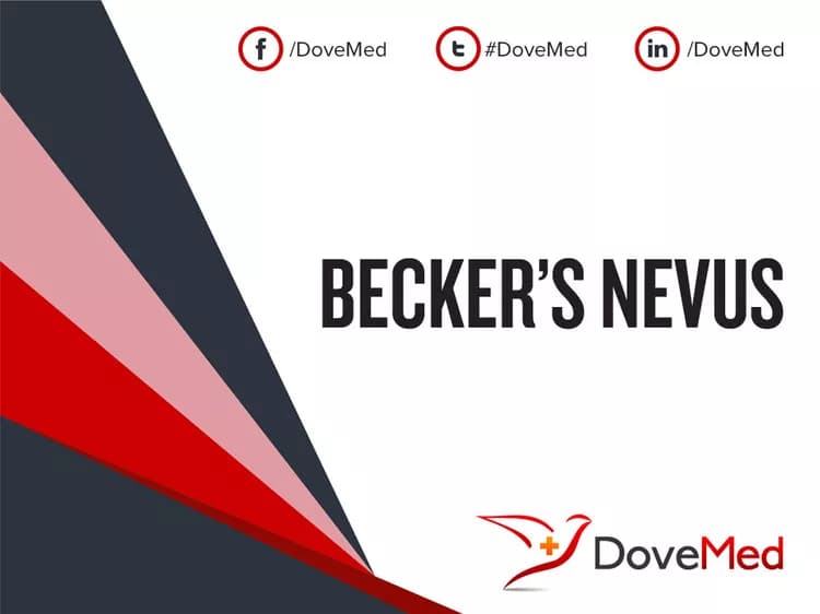 Becker’s Nevus