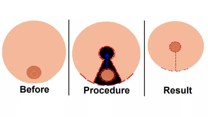Breast Reduction Surgery