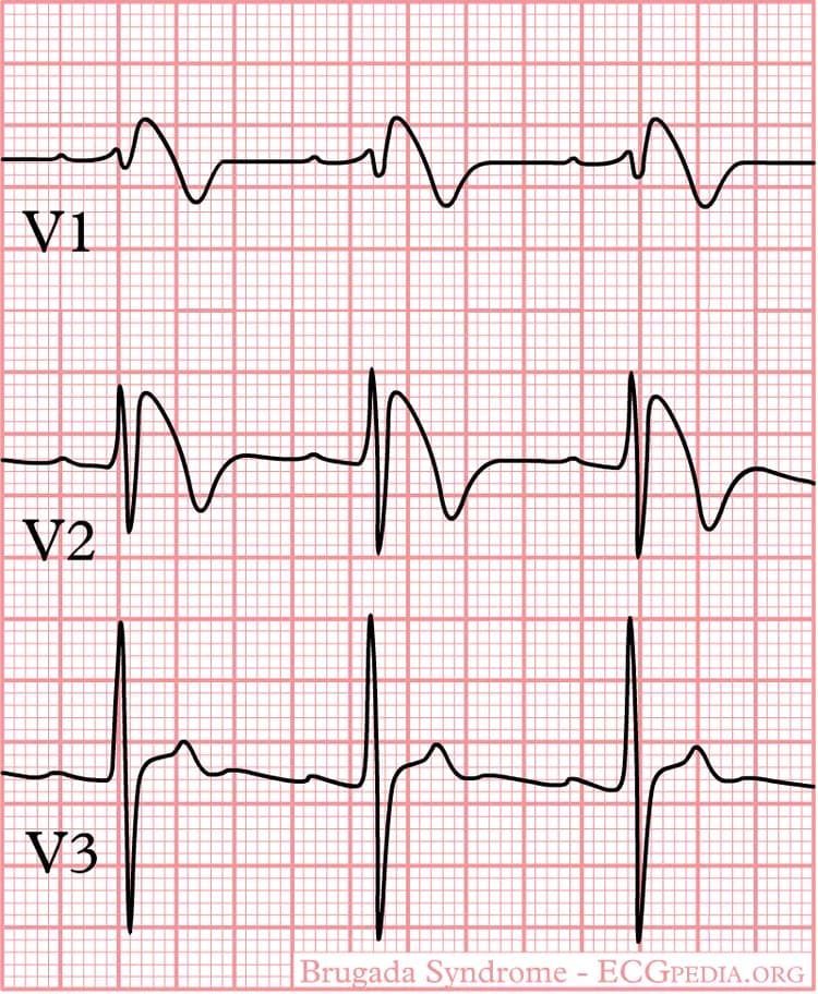 ECGPedia