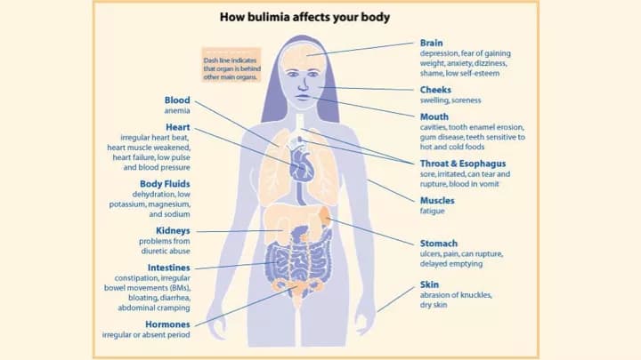 Bulimia Nervosa