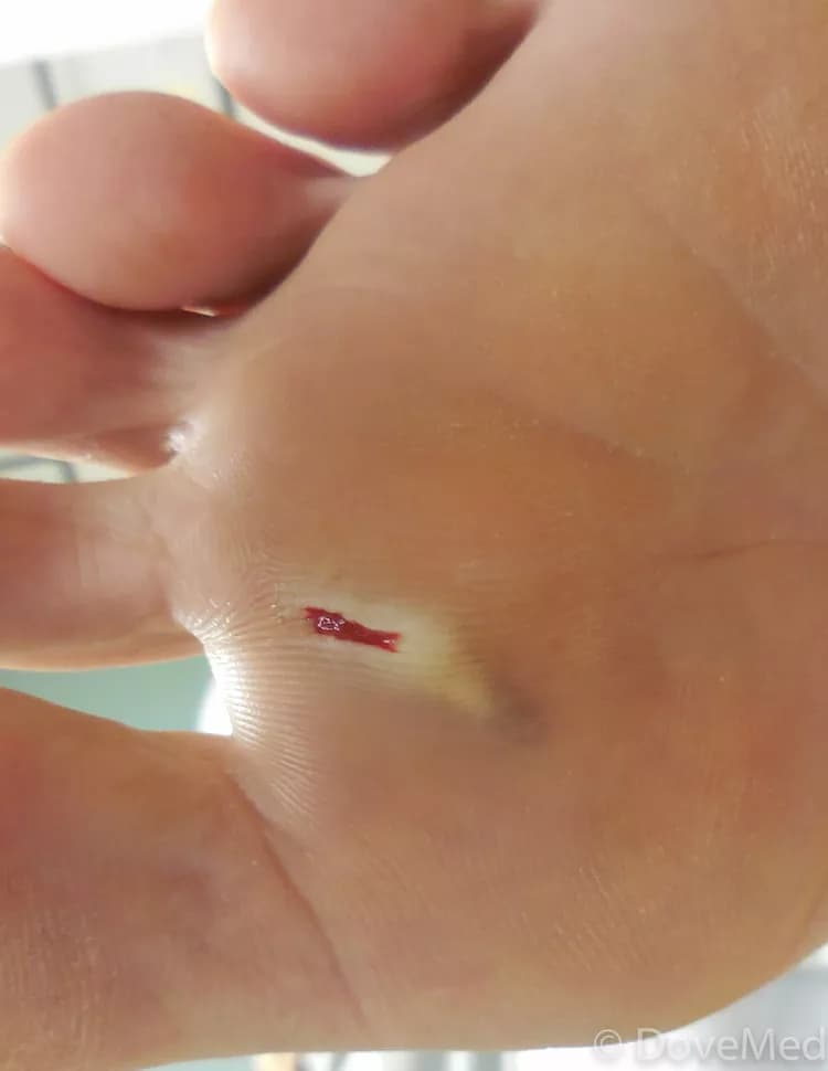 First Aid for Foreign Object in the Skin