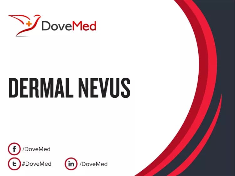 Dermal Nevus