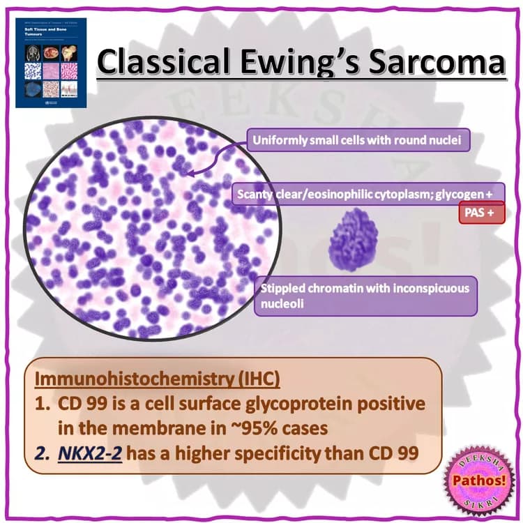 Ewing's Sarcoma: A Rare Bone Tumor of Childhood and Adolescence