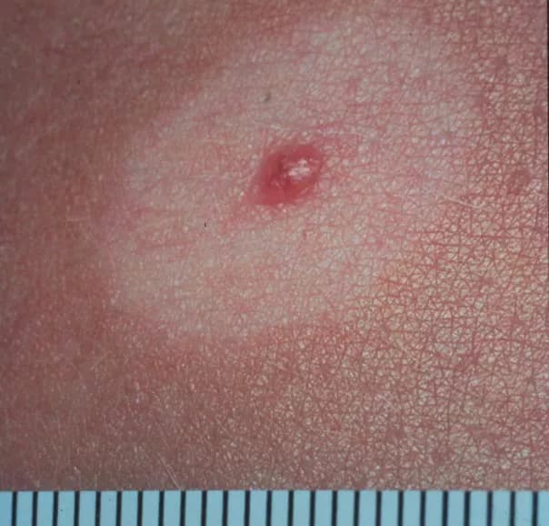 Halo Nevus