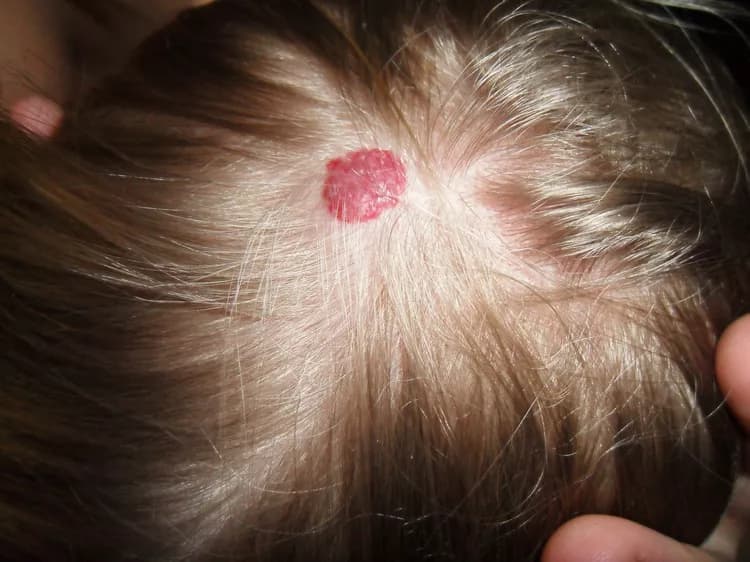 Venous Hemangioma (VH)