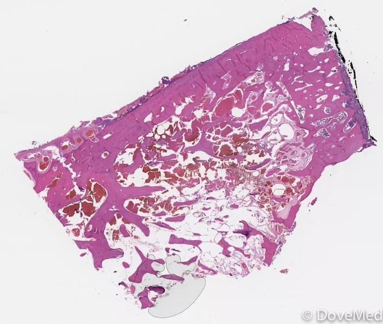 Hemangioma of the Genitourinary System