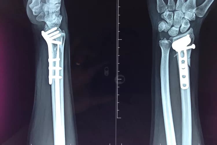 Distal Radius Fracture