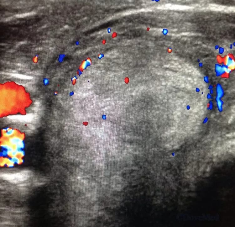 Five Vascular Diseases Linked To One Common Genetic Variant