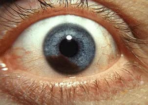 Jonathan Trobe, M.D. - University of Michigan Kellogg Eye Center