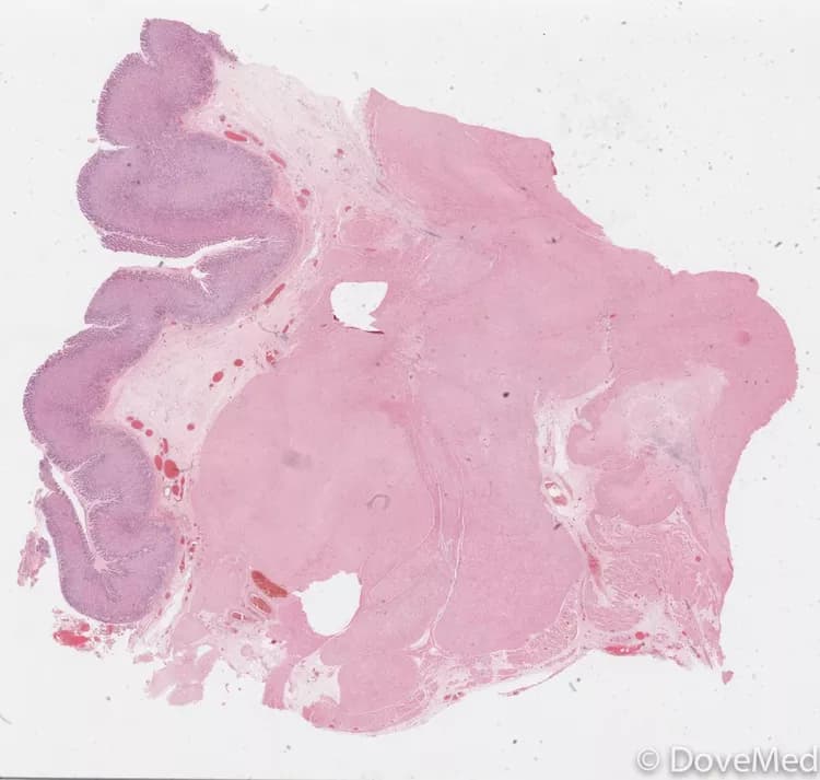 Leiomyoma of the Genitourinary System
