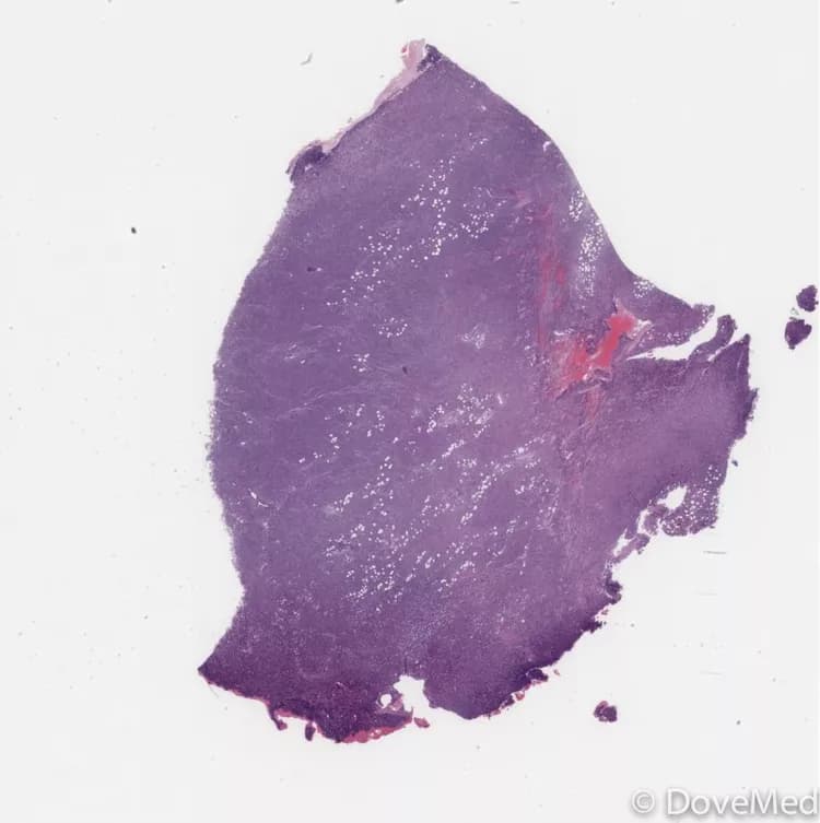 Lymphoma of Esophagus