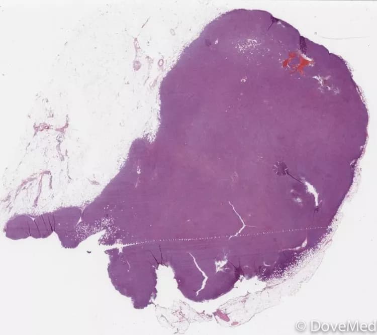 Lymphoma of Urinary Bladder