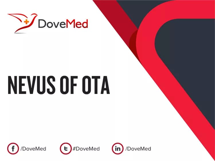 Nevus of Ota
