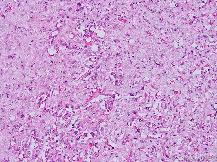 One-Step Test For Hepatitis C Virus Infection Developed