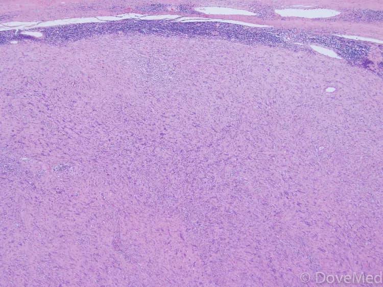 Plexiform Schwannoma