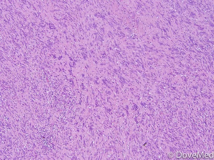 Cellular Schwannoma