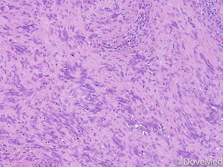 Vestibular Schwannoma