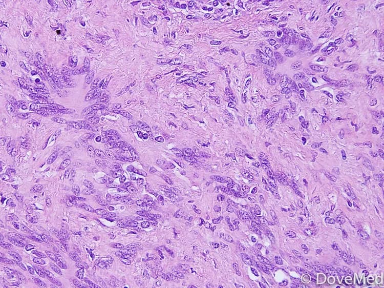 Spinal Schwannoma