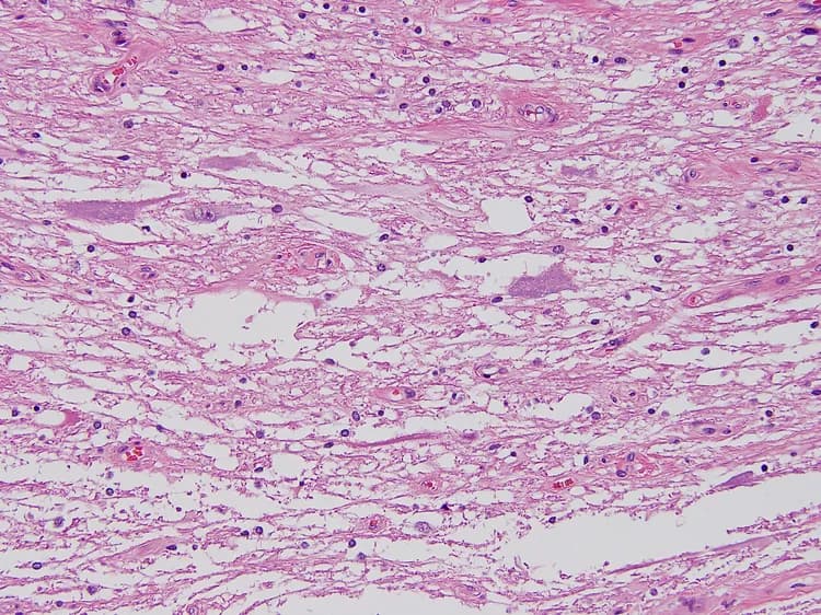 Cystic Fibrosis: Ensuring Adequate Nutrition