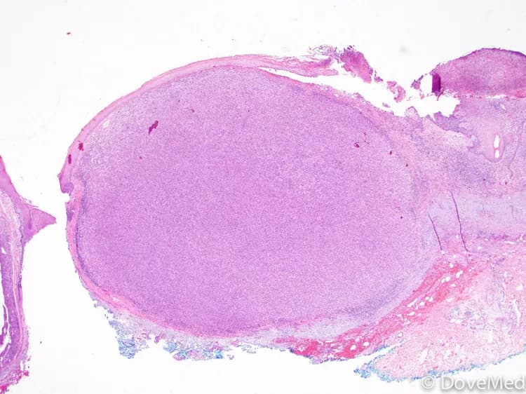 Classification of Melanoma