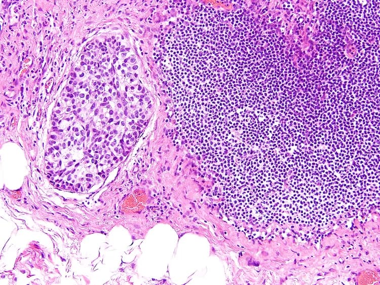 One Of The Most Common Viruses In Humans May Promote Breast Cancer Development