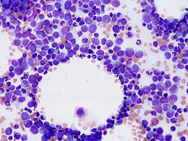 Childhood Leukemia Patients From High-Poverty Areas More Likely To Suffer Early Relapse