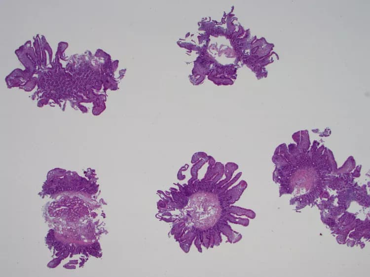 Since 1907, approximately how many cases of Whipple's Disease have been reported?