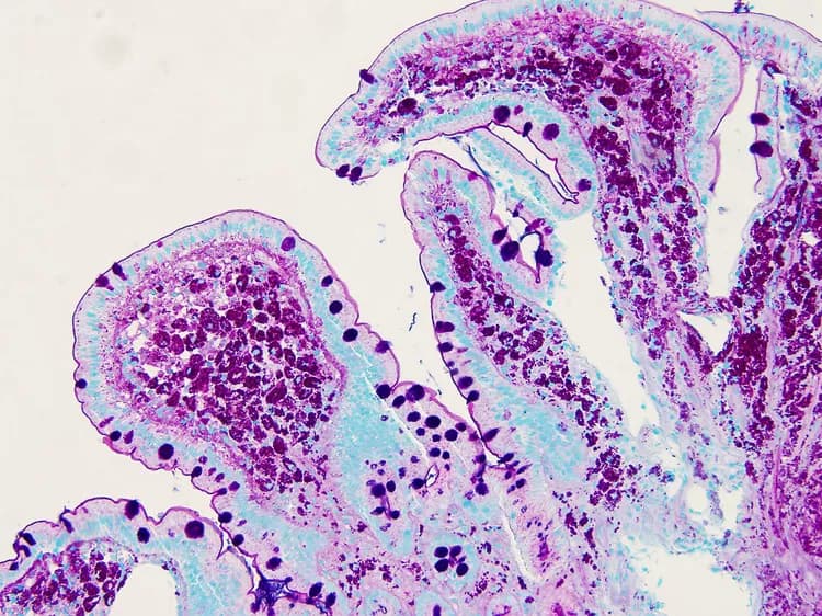 Facts about Whipple’s Disease