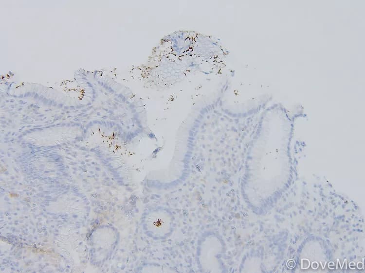New Research On Common Bacterium Opens Door To Fighting Gastric Cancer