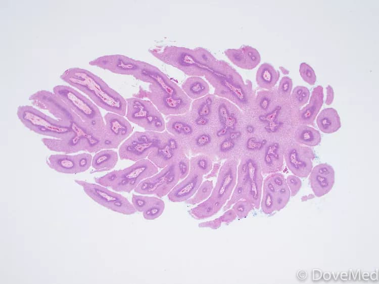 Cheek Biopsy