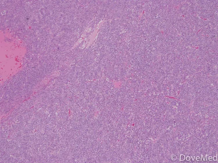 Leiomyosarcoma of Vagina