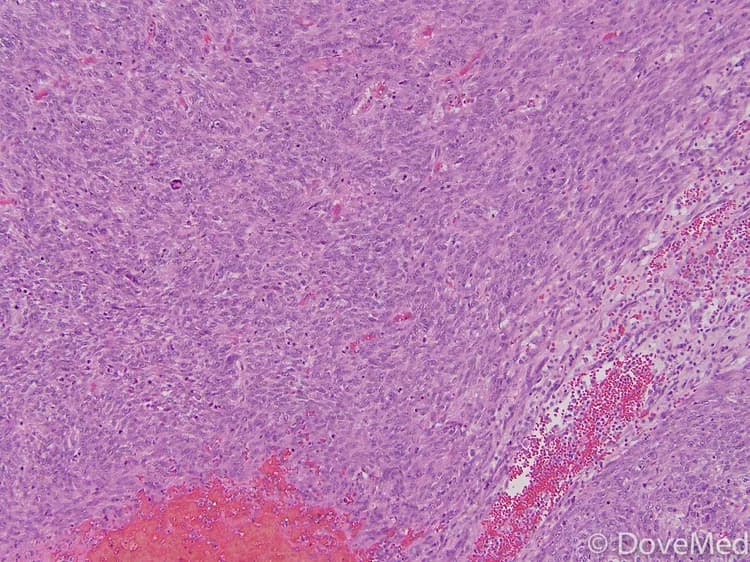 Leiomyosarcoma of Vulva