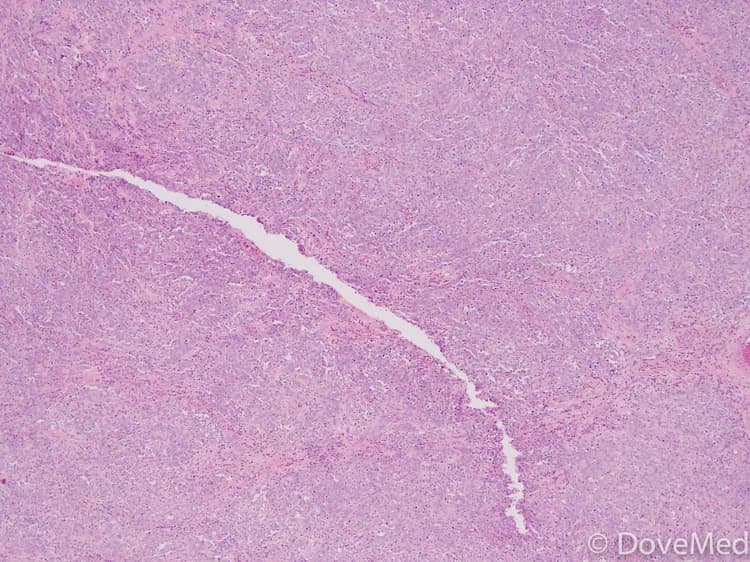 Ovarian Dysgerminoma